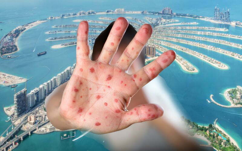 Emiratos Árabes registra primer caso de Viruela de Mono