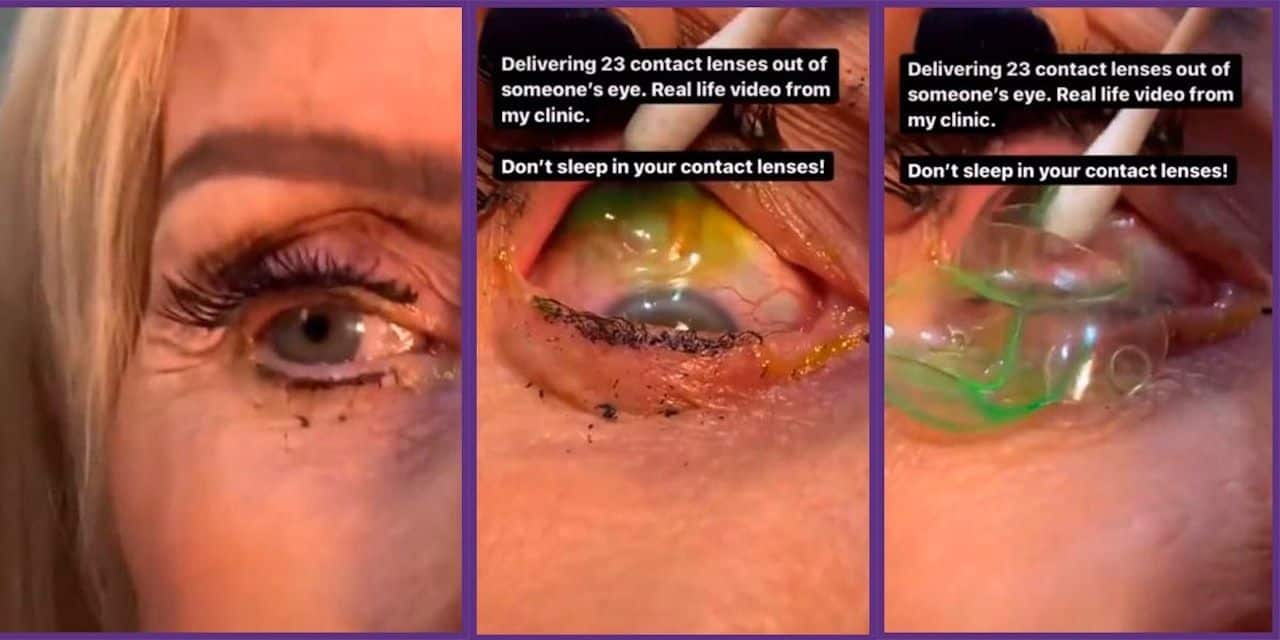 Mujer acude al oftalmólogo por “mala vista”; le retiran 23 lentes de contacto